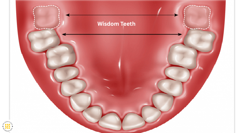 Top 7 Reasons Why Experts Now Say Not to Remove Your Wisdom Teeth